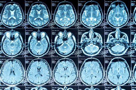 the villages mri brain|The Villages, FL Brain MRI Cost Comparison .
